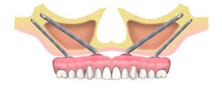 zygoma 8